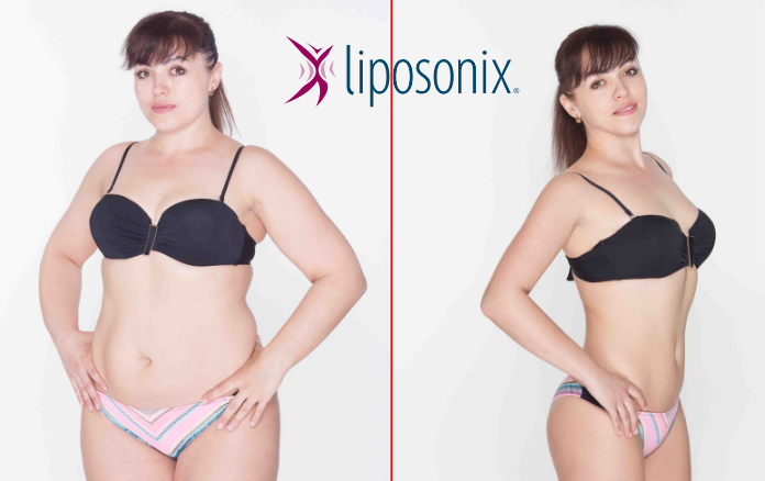 Laserová liposukce Verjú